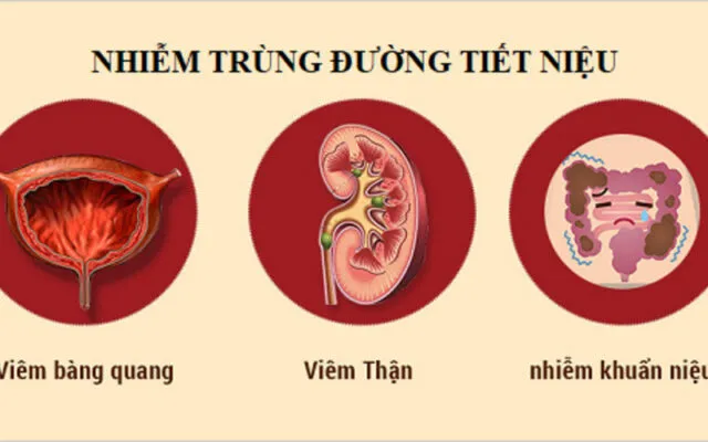 Tìm hiểu về nhiễm trùng đường tiết niệu (Nguồn: Internet)