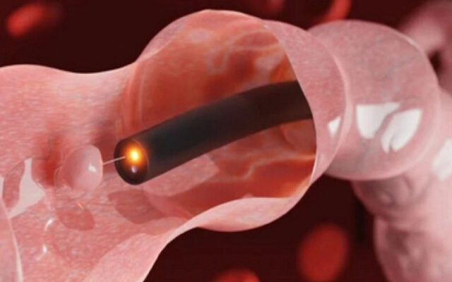 Nội soi đại tràng tầm soát ung thư (Nguồn: Internet)