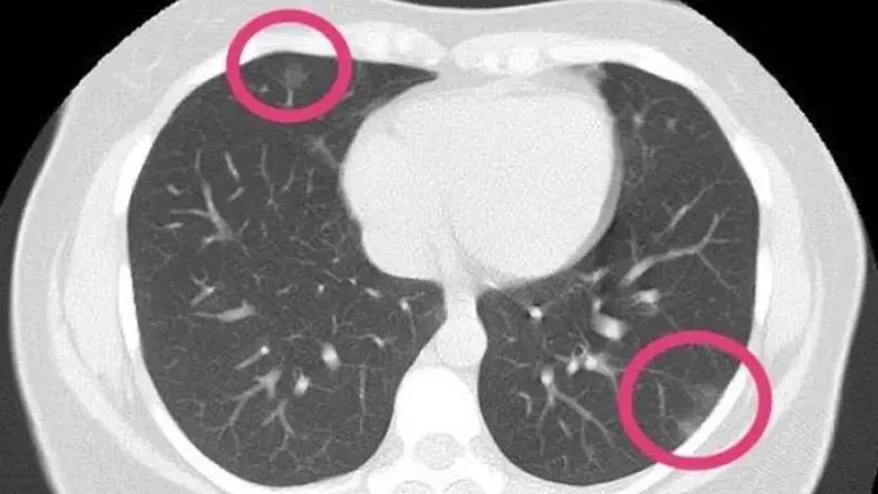 Chụp CT Scan để tầm soát ung thư phổi (Nguồn: Internet)