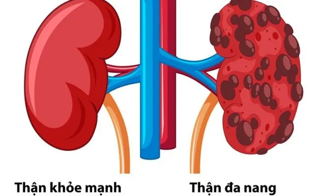 Thận đa nang (Nguồn: Internet)