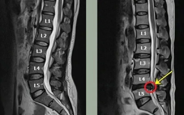 Thoát vị đĩa đệm L4 L5 (Nguồn: Internet)