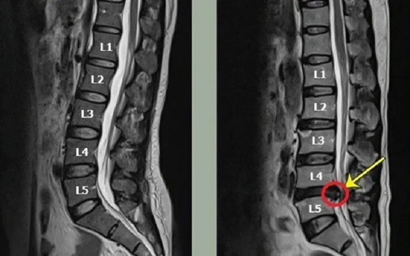 Thoát vị đĩa đệm L4 L5 (Nguồn: Internet)