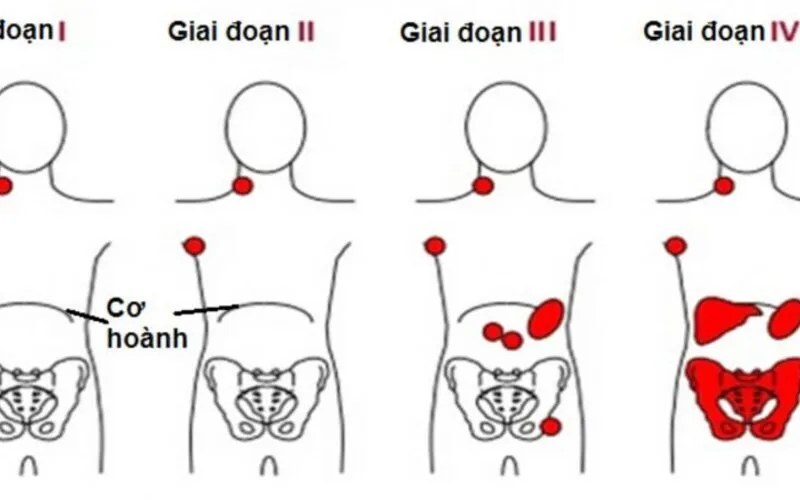 Các giai đoạn của u lympho không hodgkin (Nguồn: Internet)