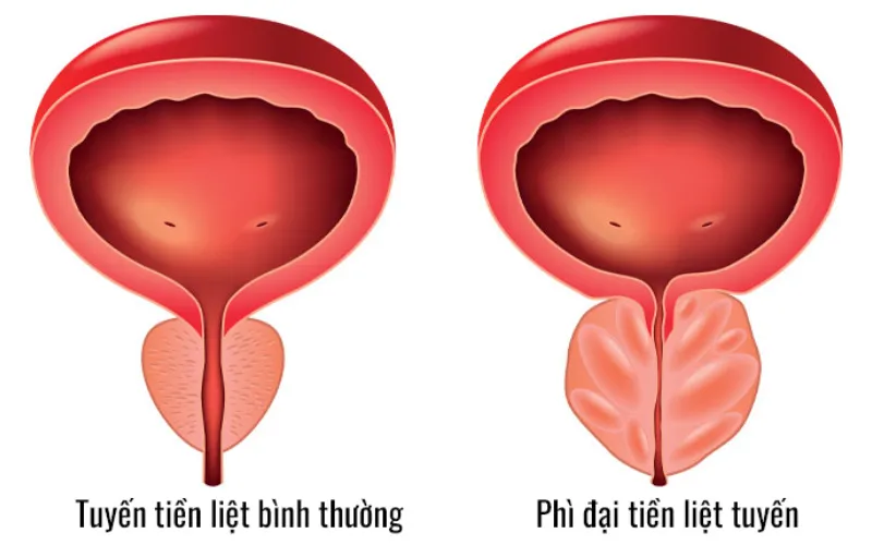 U phì đại tuyến tiền liệt là gì? (Nguồn: Internet)