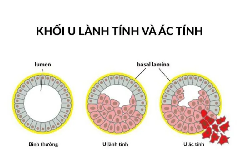 Phân biệt u lành và u ác tính (Nguồn: Internet)