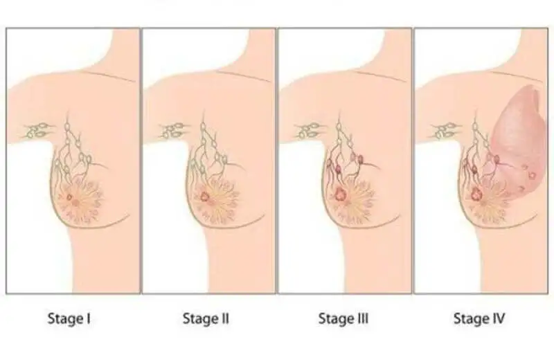 Các giai đoạn ung thư biểu mô tuyến vú (Nguồn: Internet)