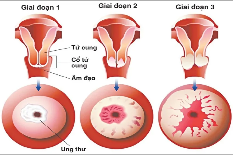 Ung thư cổ tử cung giai đoạn 1 (Nguồn: Internet)