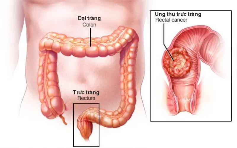 Ung thư đại tràng giai đoạn cuối là gì? (Nguồn: Internet)