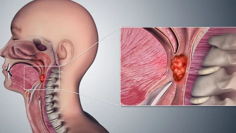 Ung thư vòm hầu là gì? (Nguồn: Internet)