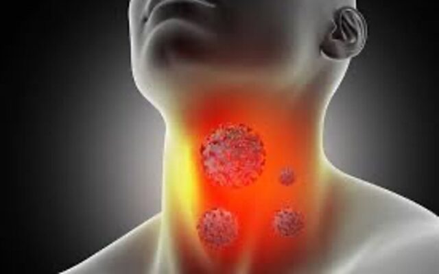 Tìm hiểu về ung thư vòm họng giai đoạn đầu (Nguồn: Internet)