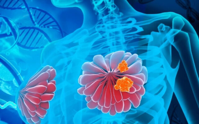 Ung thư vú là g(Nguồn: Internet)