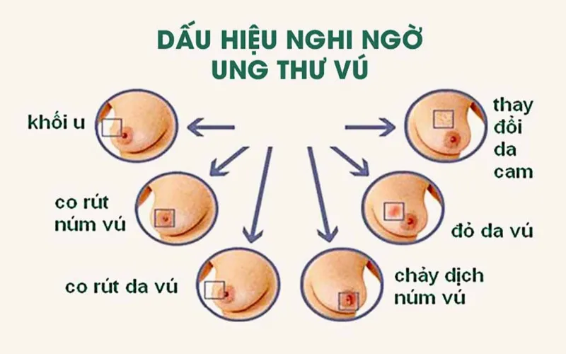 Triệu chứng ung thư vú khi cho con bú (Nguồn: Internet)