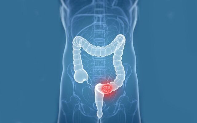Ung thư trực tràng (Nguồn: Internet)