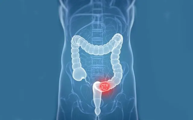 Ung thư trực tràng (Nguồn: Internet)