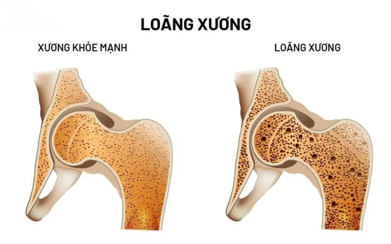 Loãng xương là gì? (Nguồn: Internet)