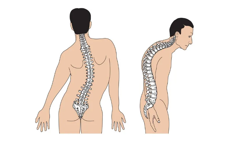 Gù lưng, biến dạng cột sống - Dấu hiệu loãng xương cần chú ý (Nguồn: Internet)