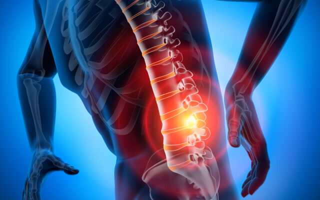 Thoát vị đĩa đệm mông (Nguồn: Internet)