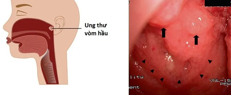 Nghẹt mũi và chảy mũi - Dấu hiệu ung thư vòm họng ở phụ nữ (Nguồn: Internet)