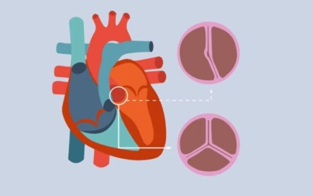 Hẹp van động mạch chủ (Nguồn: Internet)