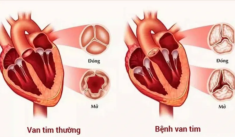 Hở van 2 lá có nguy hiểm không (Nguồn: Internet)