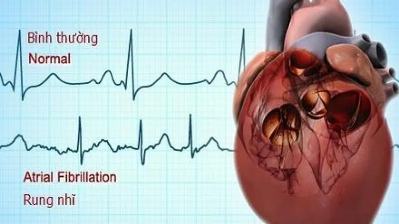 Rung nhĩ là một trong những biến chứng của bệnh hở van 2 lá (Nguồn: Internet)