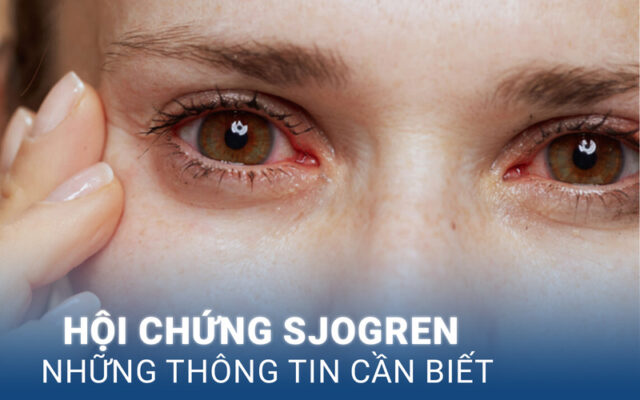 Hội chứng Sjogren (Nguồn: Internet)