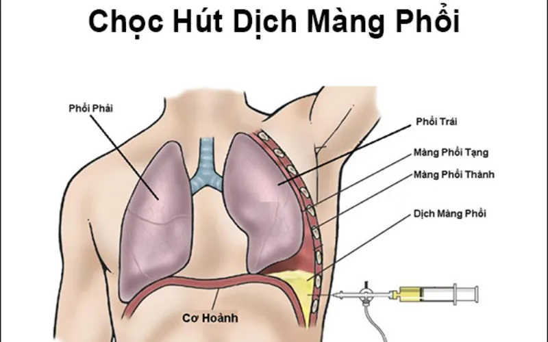 Chọc hút dịch màng phổi (Nguồn: Internet)