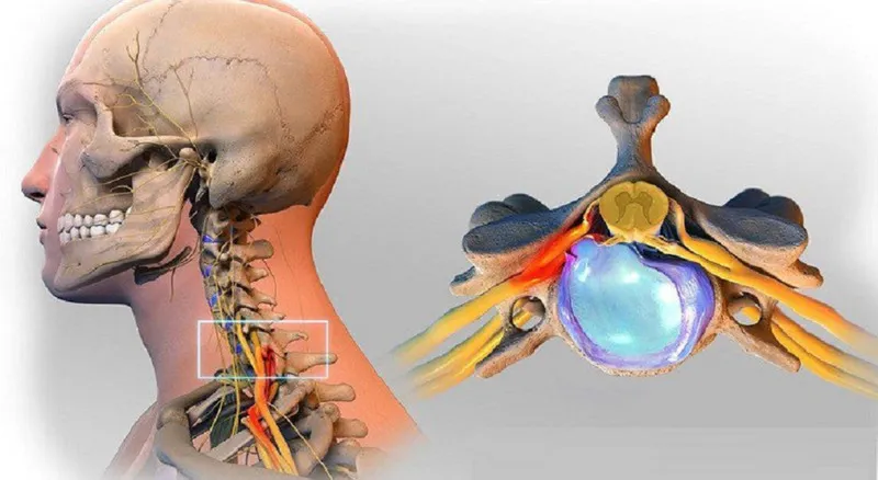 Thoát vị đĩa đệm cổ là gì? (Nguồn: Internet)