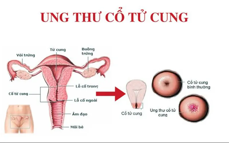 Ung thư cổ tử cung là gì? (Nguồn: Internet)