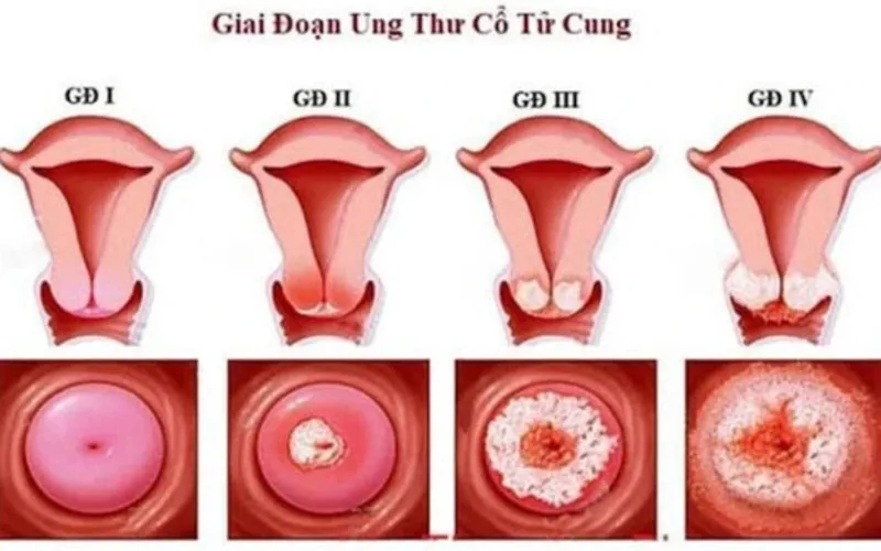 Ung thư cổ tử cung sống được bao lâu ở mỗi giai đoạn? (Nguồn: Internet)