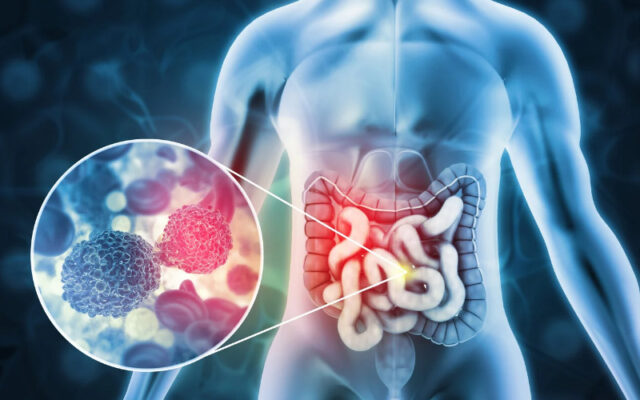 Ung thư đại tràng giai đoạn 1 là gì? (Nguồn: Internet)