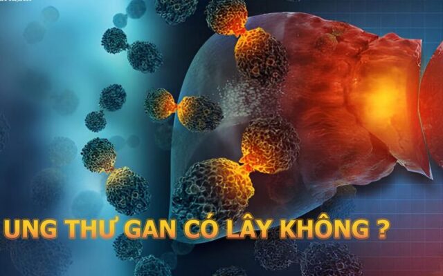 Ung thư gan có lây không? (Nguồn: Internet)
