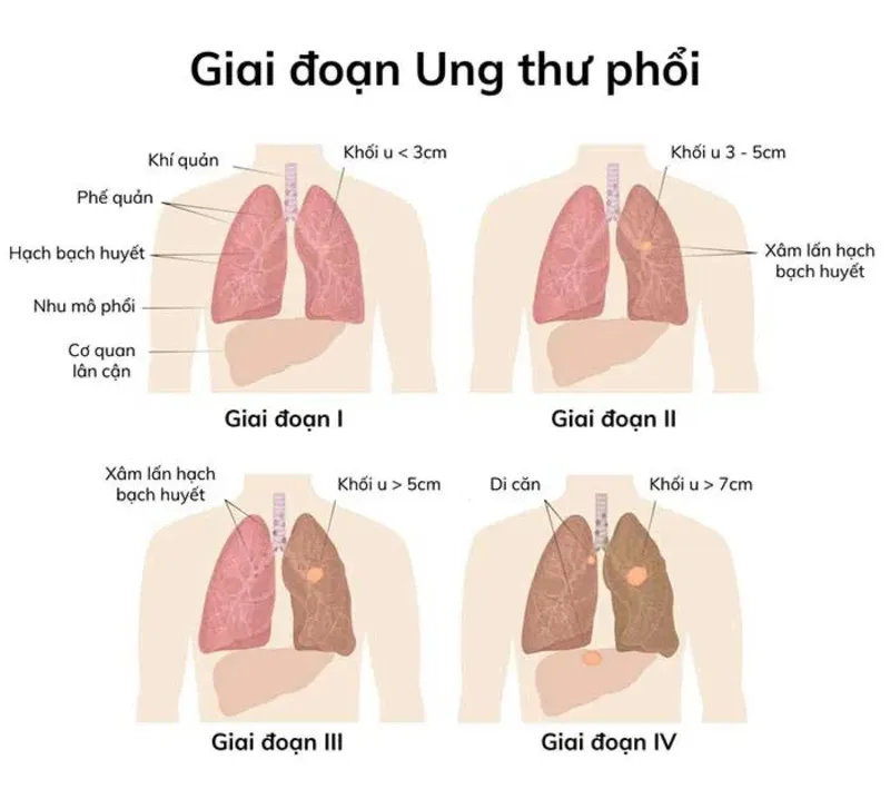 Ung thư phổi sống được bao lâu theo giai đoạn ung thư phổi (Nguồn: Internet)