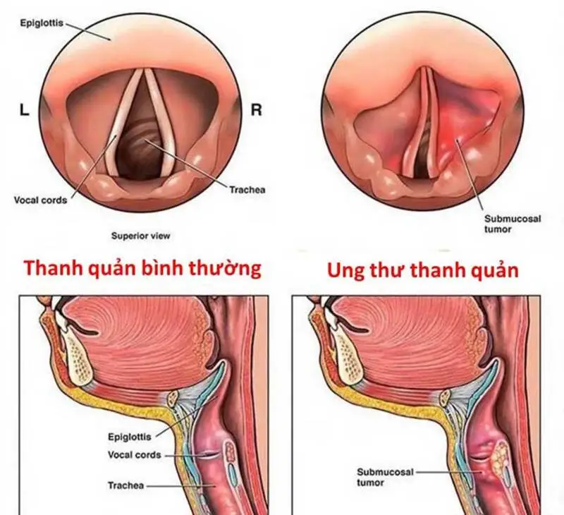 Ung thư thanh quản giai đoạn đầu là gì? (Nguồn: Internet)