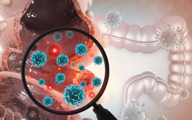 Ung thư trực tràng giai đoạn 2 (Nguồn: Internet)