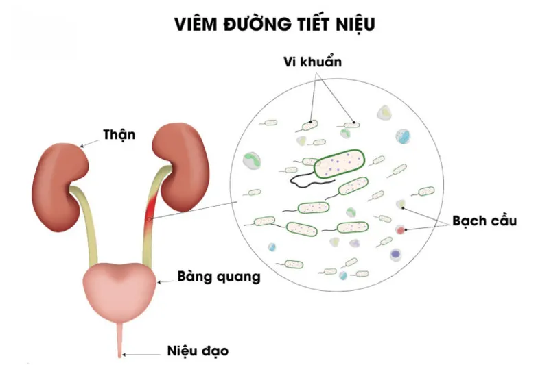 Viêm đường tiết niệu là gì? (Nguồn: Internet)