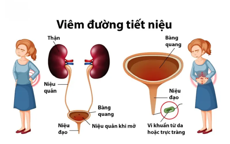 Nhiễm trùng tái phát (Nguồn: Internet)