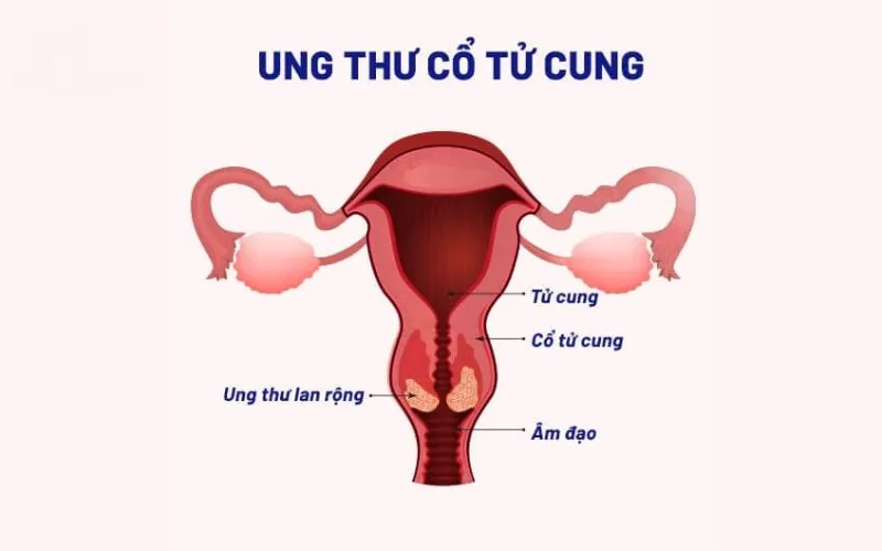 Ung thư cổ tử cung là gì? (Nguồn: Internet)