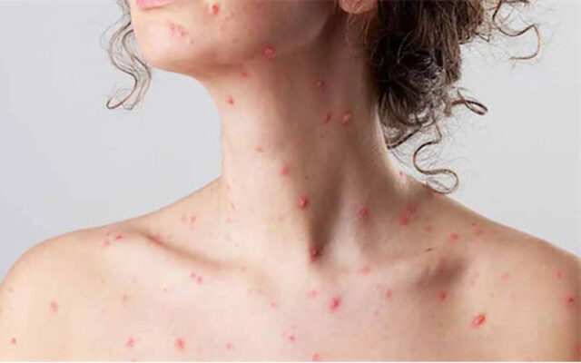 Bệnh bóng nước tự miễn (Nguồn: Internet)