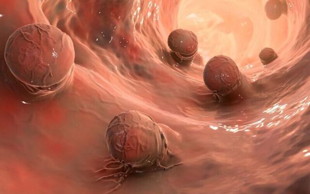 Đa polyp đại tràng (Nguồn: Internet)