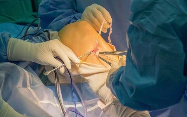 Đứt dây chằng chéo trước có cần mổ không? (Nguồn: Internet)