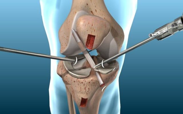 Mổ đứt dây chằng chéo trước (Nguồn: Internet)