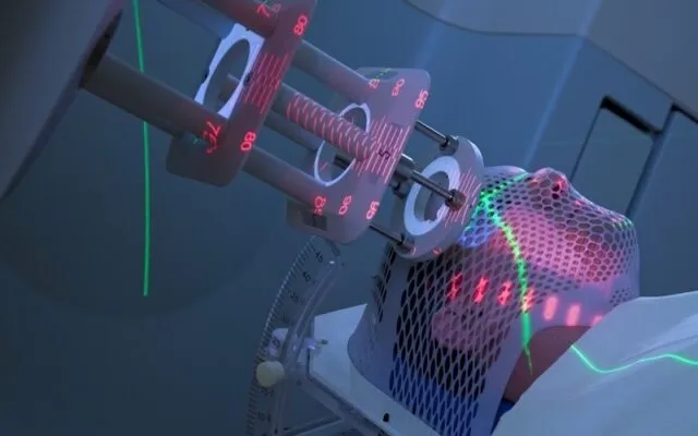 Xạ trị (Nguồn: Internet)