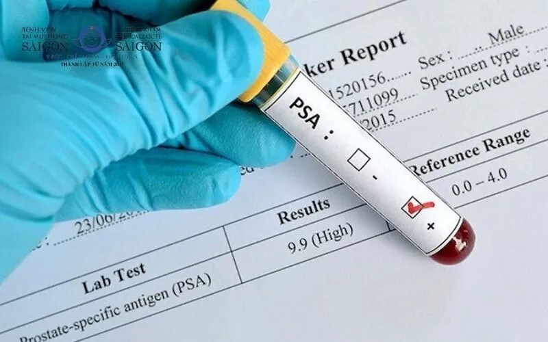 Tầm soát ung thư tiền liệt tuyến bằng xét nghiệm PSA (Nguồn: Internet)