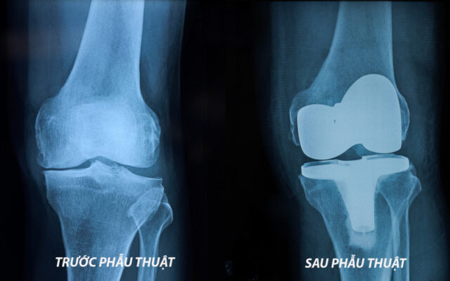 Thay khớp gối (Nguồn: Internet)