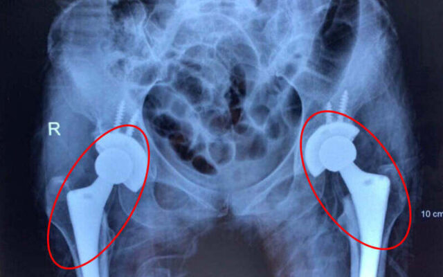 Thay khớp háng (Nguồn: Internet)