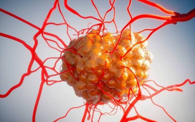 U thần kinh nội tiết (Nguồn: Internet)