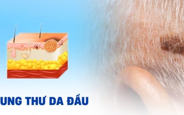 Ung thư da đầu (Nguồn: Internet)
