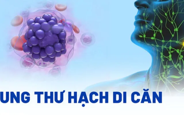Ung thư hạch di căn (Nguồn: Internet)