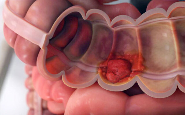 Ung thư ruột già (Nguồn: Internet)
